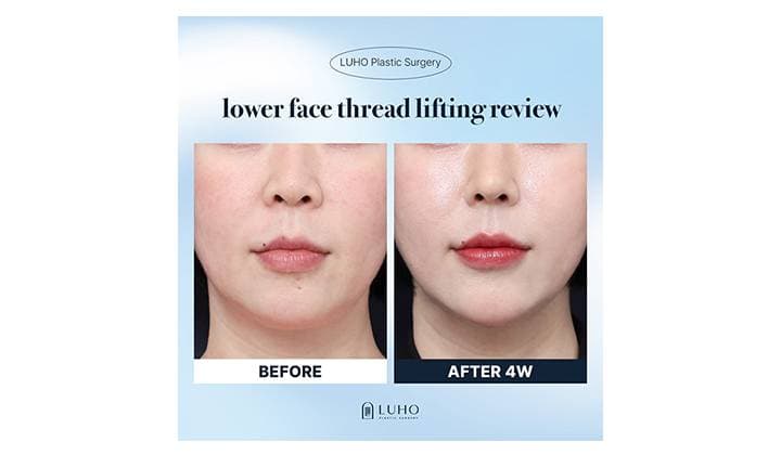 Jawline Thread Lift Before & After at LUHO Plastic Surgery