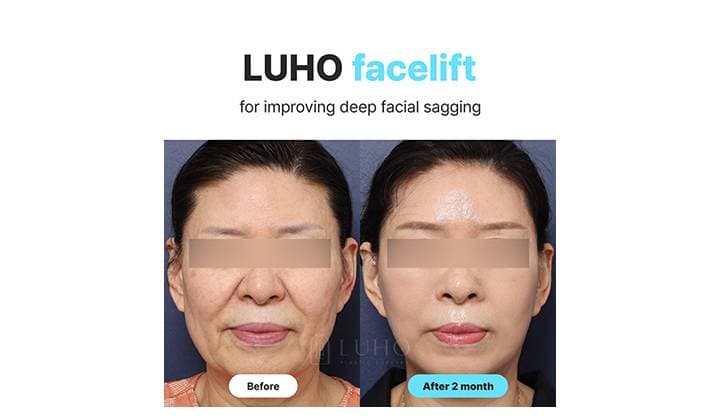 Restoring Facial Contours with Facelift Surgery | Before & After