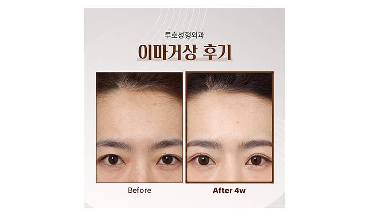 신사역 이마거상으로 자연스러운 동안 라인 완성