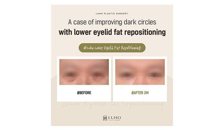 How Lower Eyelid Fat Repositioning Improved Dark Circles