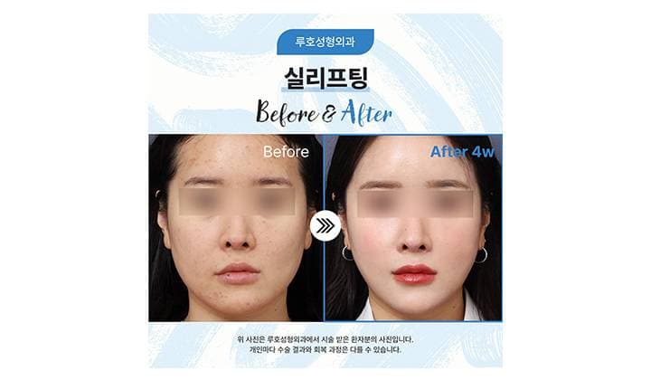 늘어진 하안면을 신사역 실리프팅을 통해 정리한 후기