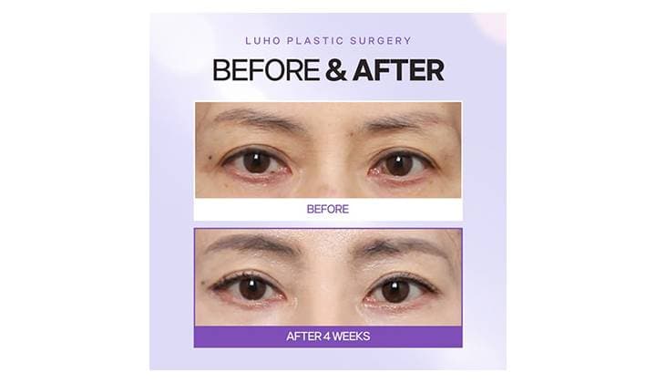 Sinsa Plastic Surgery: A Real Case of Lifting Drooping Eye Corners