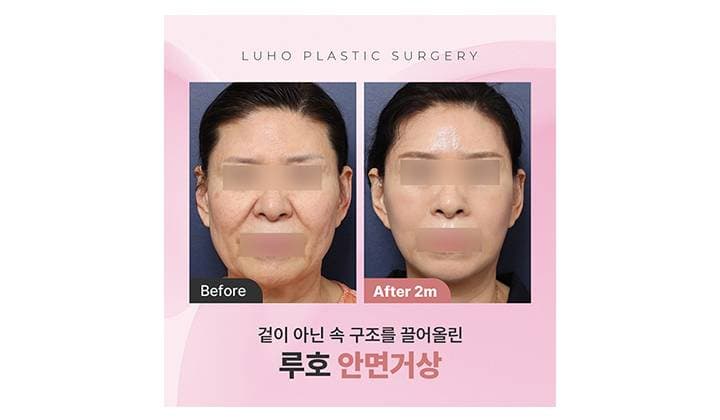 60대 안면거상, 구조를 끌어올려 변화를 만든 후기