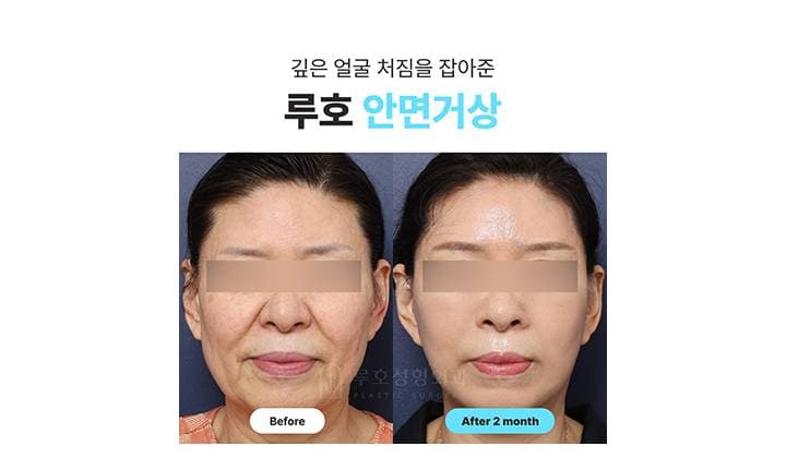 깊은 얼굴 처짐을 줄여준 신사역 안면거상 후기
