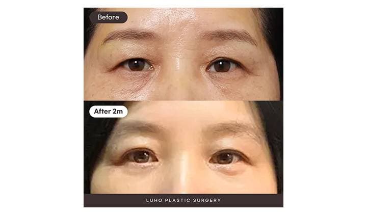 신사역 상안검 수술 : 중년 눈 처짐 교정한 사례