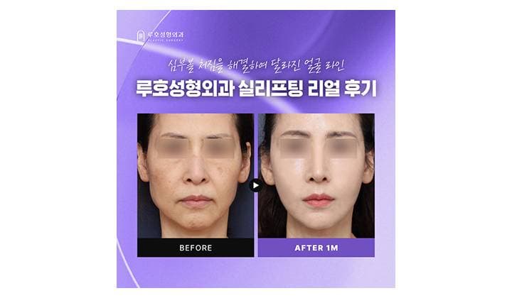 심부볼 처짐 해결한 신사역 실리프팅 후기