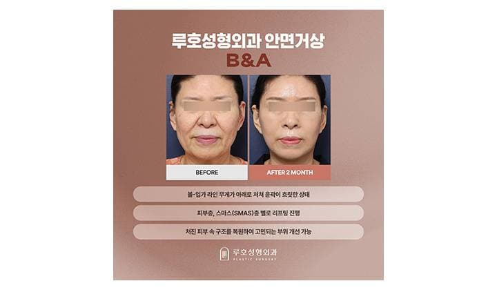 처진 얼굴선 해결한 신사역 안면거상잘하는곳 후기
