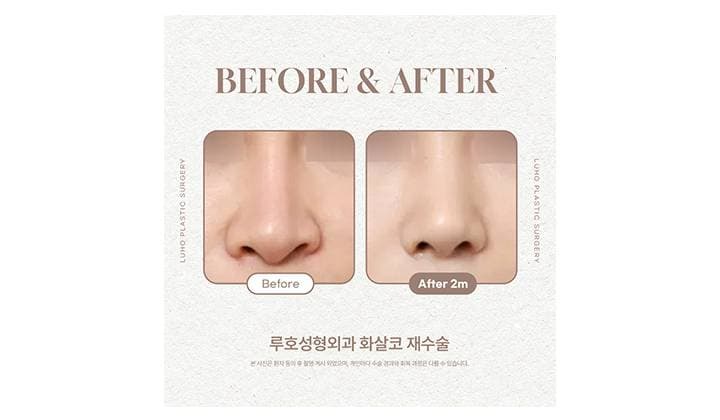 신사역 화살코 수술로 달라진 변화 알아보기