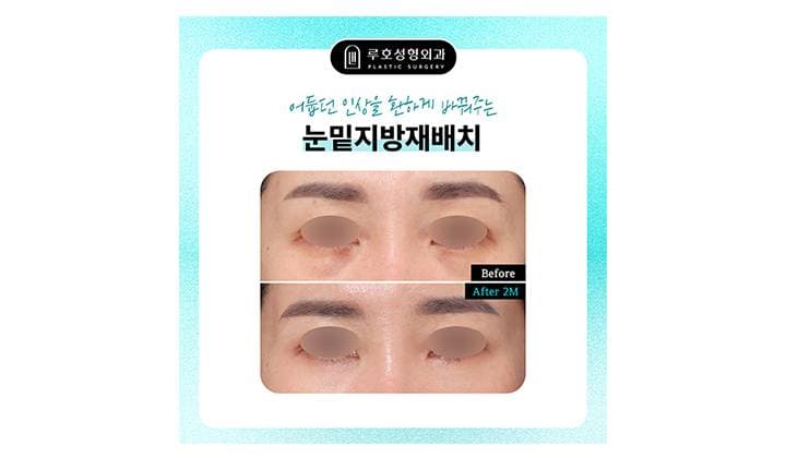 강남 신사역 눈밑지방재배치 수술, 인상을 바꿔놓은 효과