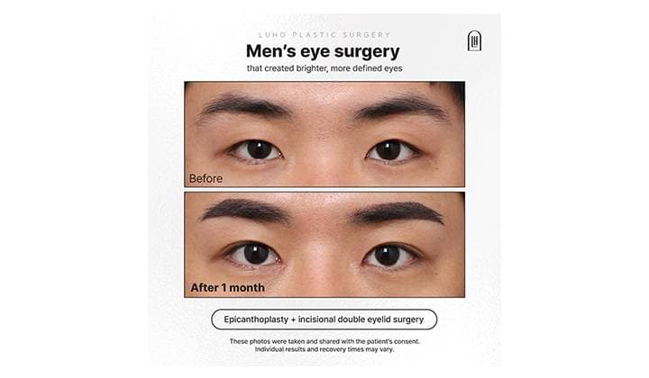 Before & After: Men’s Eye Surgery in Gangnam Near Sinsa