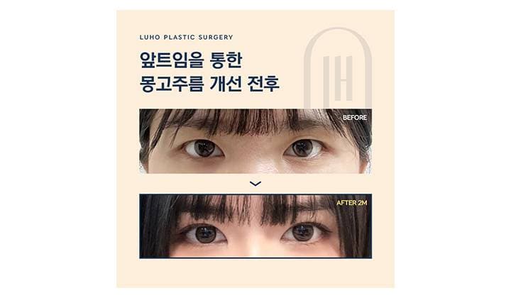 신사역 앞트임 2개월 차 실제 사례