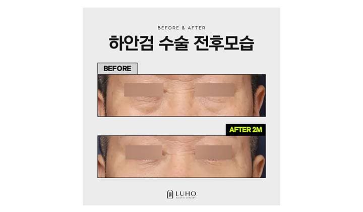 신사역 눈 밑 처짐, 하안검 수술 실제 케이스