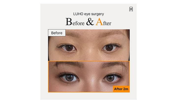 How Eye Surgery Transformed the Eyes and Overall Expression