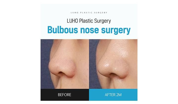 Achieving a Refined Nasal Line with Bulbous Tip Surgery near Sinsa Station, Gangnam