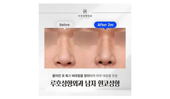 강남 신사역 남자코성형 유형을 고려한 접근으로 바뀐 모습