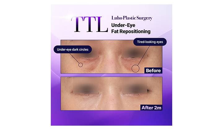 Under-Eye Fat Repositioning at Sinsa Station to Improve Dark Circles