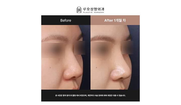 신사역 복코 재수술 전후 : 날렵한 콧대로 바꿔 준 사례