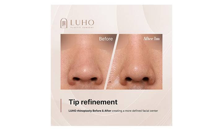 A More Defined Facial Profile: Male Rhinoplasty in Gangnam