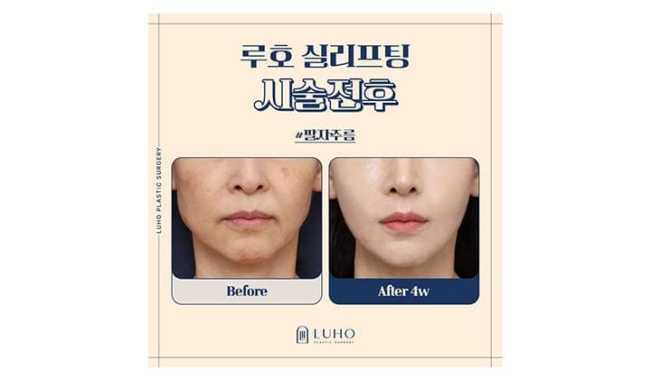신사역 실리프팅 후기로 팔자주름 변화 살펴보기
