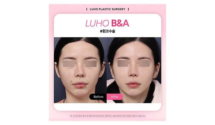 휘어진 코를 바르게 교정한 신사역 휜코수술 사례
