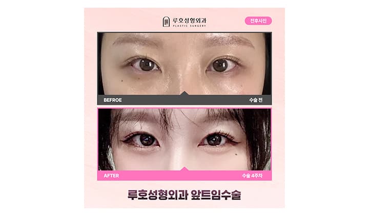 실제 앞트임수술 경과별 비교하기