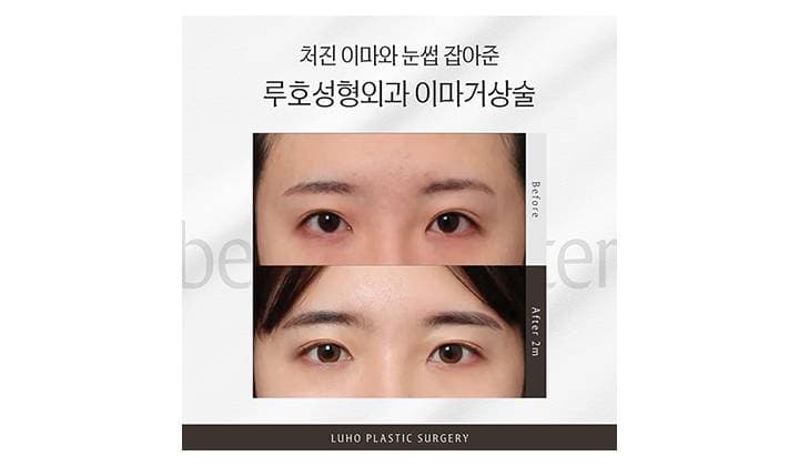 처진 이마, 눈썹 동시에 바꿔준 신사역 이마거상술 후기