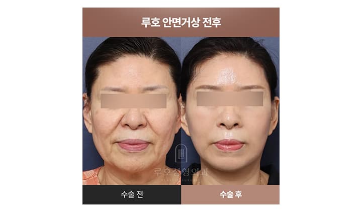 리얼 안면거상 후기 살펴보기