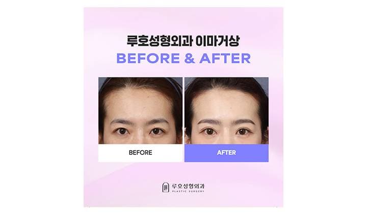 처진 인상 바꿔준 신사역 이마거상 후기