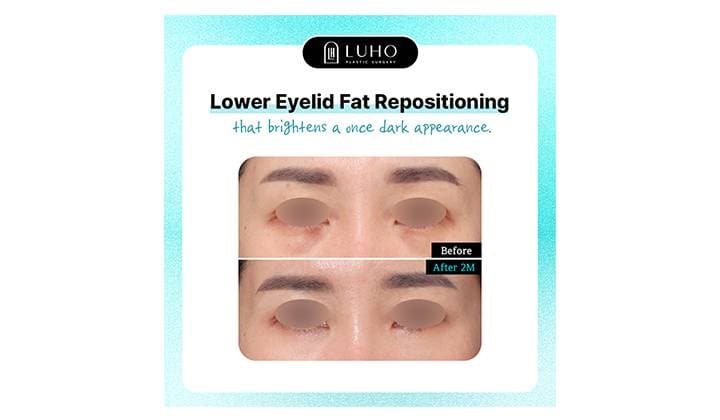 Lower Eyelid Fat Repositioning in Gangnam: How It Can Refresh Your Appearance