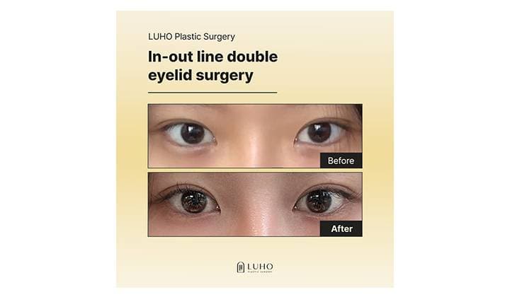 A Noticeable Difference After Double Eyelid Surgery: A Before & After Review