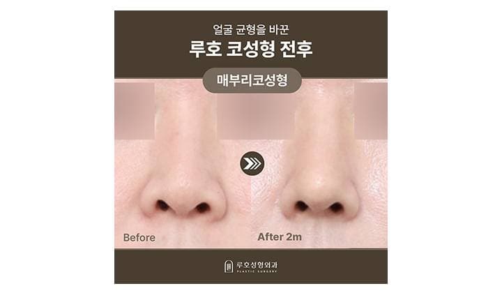 신사역 코성형으로 조화로운 얼굴을 만든 사례