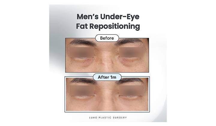Men’s Under-Eye Fat Repositioning Near Sinsa Station: A Brighter, More Refreshed Look