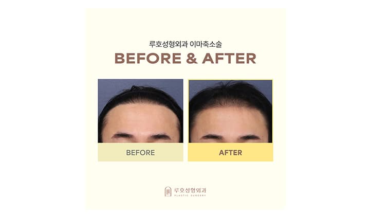 이마축소술 전후 리얼 후기