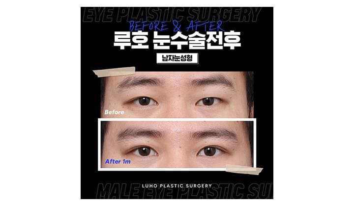 또렷한 눈매로 바뀐 신사역 남자눈성형 잘하는 곳 후기
