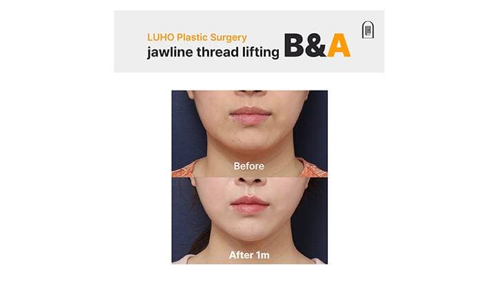 Gangnam Sinsa Thread Lift Before & After: Restoring Facial Balance and Definition