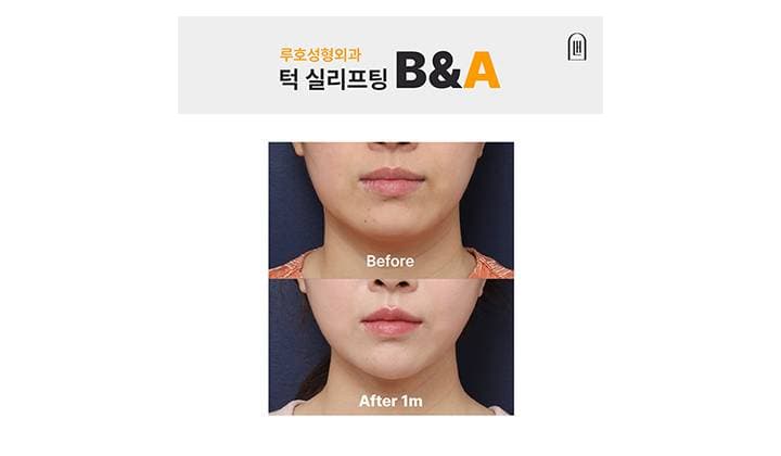 얼굴 밸런스와 라인을 동시에 잡은 강남 신사역 실리프팅 전후