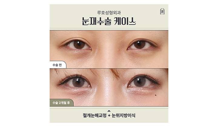 신사역 눈재수술로 또렷해진 눈매 살펴보기