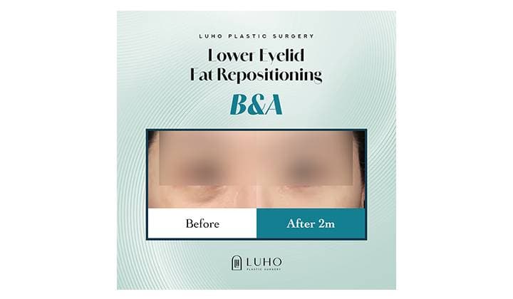 Under-Eye Shadows Caused by the Tear Trough: Improving Structural Dark Circles with Lower Eyelid Fat Repositioning