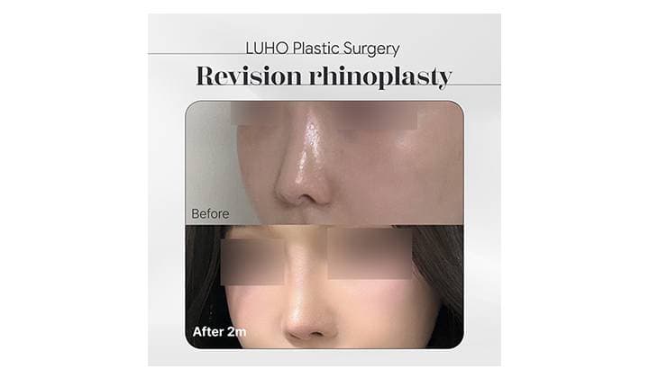 Revision Rhinoplasty in Gangnam for a Contracted Nose: A Personalized Approach Based on Structural Analysis