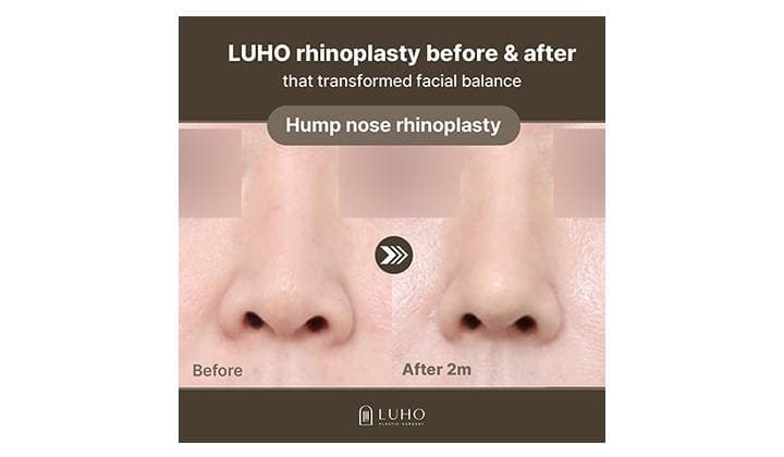 Achieving Facial Harmony with Rhinoplasty Near Sinsa Station: A Real Patient Case