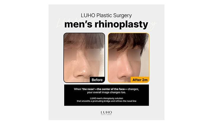 Men’s Rhinoplasty Before & After: A Naturally Balanced Profile