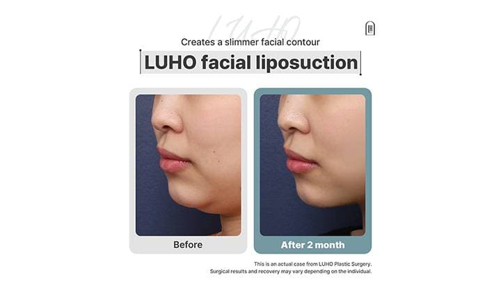 Gangnam Sinsa Facial Liposuction: A Closer Look at the Results