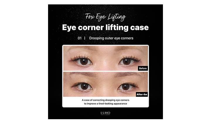 A clearer eye shape after horizontal eye extension at Sinsa