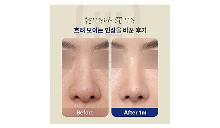 인상을 선명하게 만들어 준 신사역 코끝 성형 후기