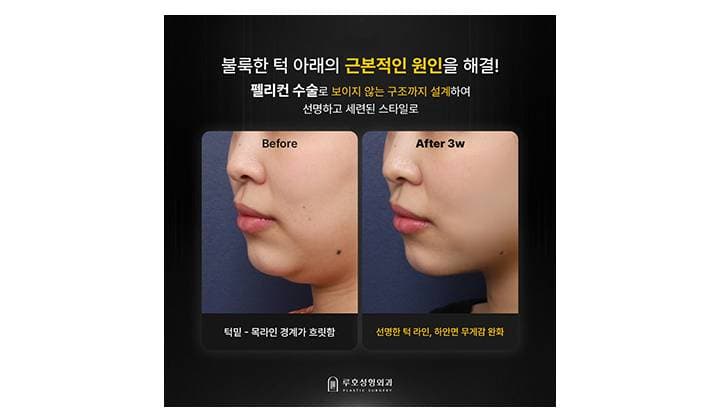 턱라인을 매끄럽게 만든 강남 신사역 이중턱살제거 수술