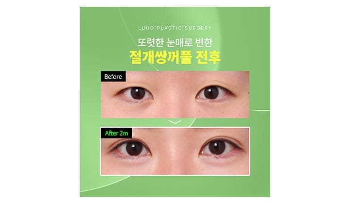자연스럽고 또렷한 눈매로 변한 신사역 눈 성형외과 후기