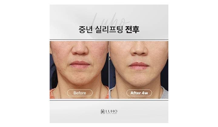 신사역 중년 실리프팅으로 하안면 무게감을 줄인 사례