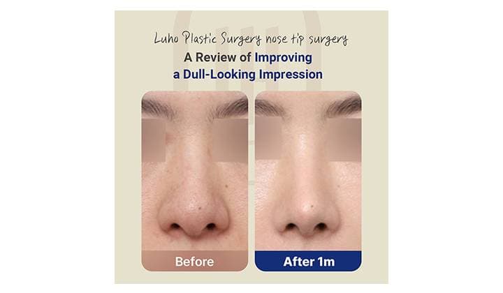 Sinsa nose tip surgery review that created a more defined impression