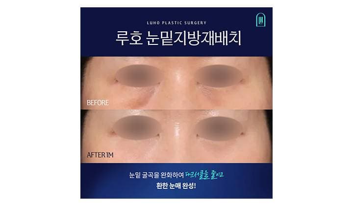 무겁게 느껴지는 다크서클 완화해 준 강남 신사역 눈밑지방재배치 후기