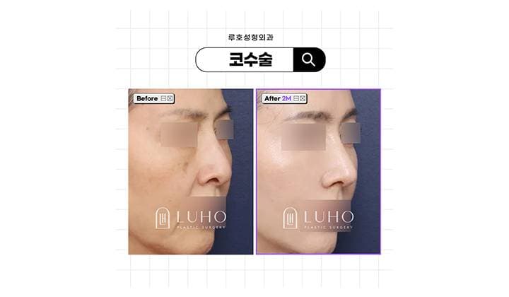 입체감 있는 라인을 만들어 준 긴코성형